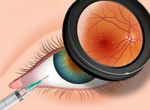 Thoái hóa điểm vàng và cách điều trị thoái hóa điểm vàng hiệu quả